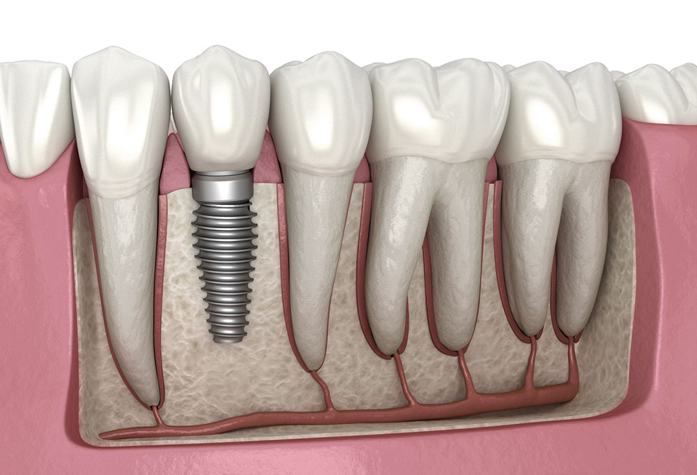 Dental Implants at Lang Lang Dental Care